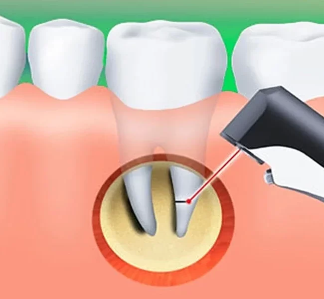 Apicoectomy Surgery