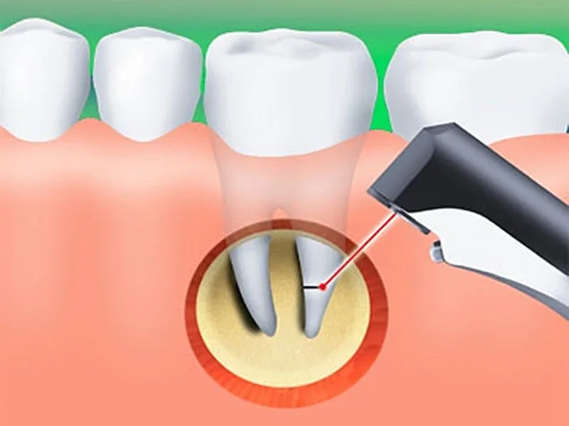 Apicoectomy Surgery