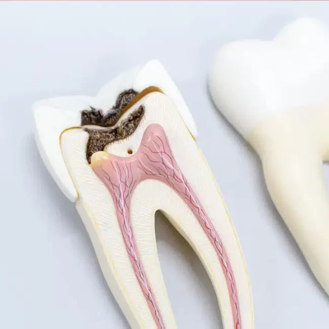 Root Canal Retreatment